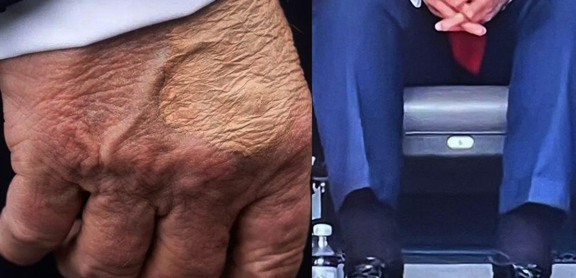 Diagnostican a Trump con insuficiencia venosa tras imágenes de inflamación