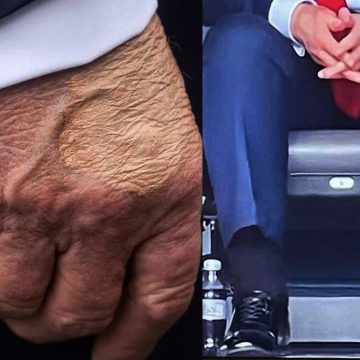 Diagnostican a Trump con insuficiencia venosa tras imágenes de inflamación