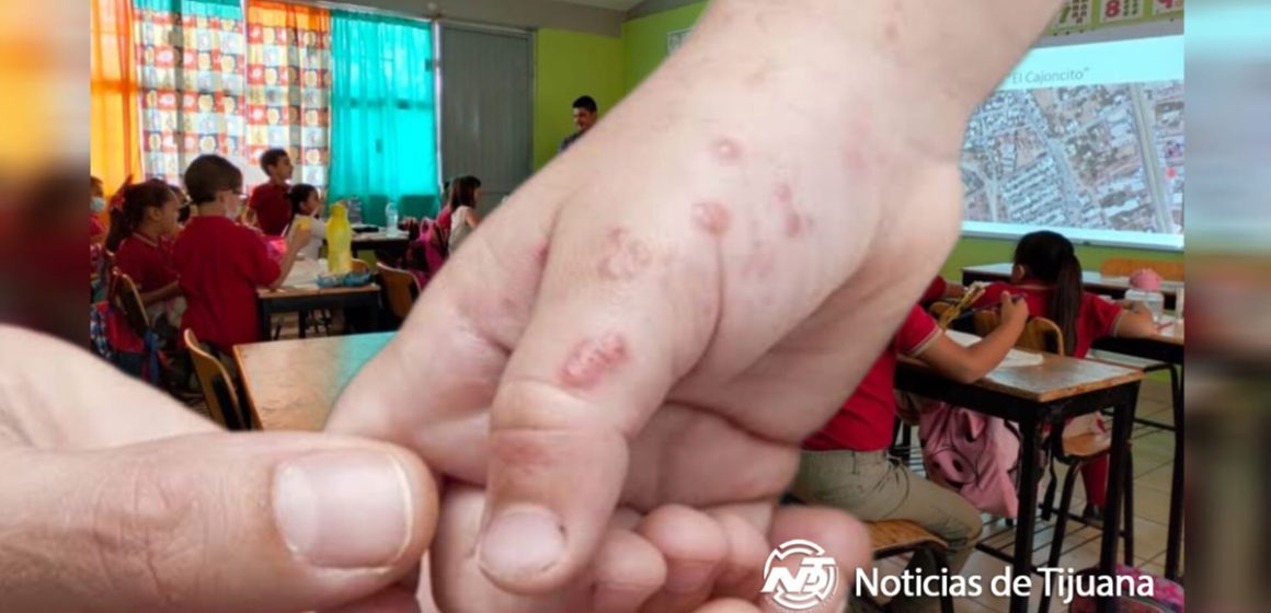 Alerta sanitaria en Baja California: Suspenden clases presenciales por aumento de casos de Coxsackie