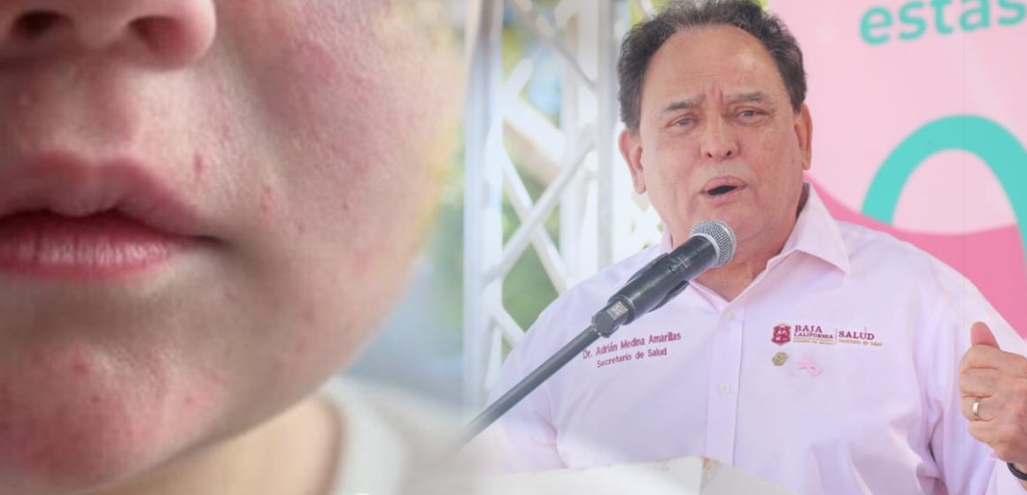 zczxc Refuerzan vigilancia sanitaria para evitar brote de sarampión en Baja California